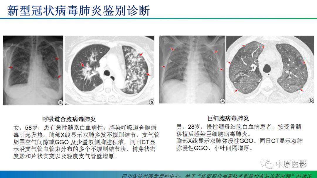 全球冠状病毒肺炎最新资讯及应对策略动态更新